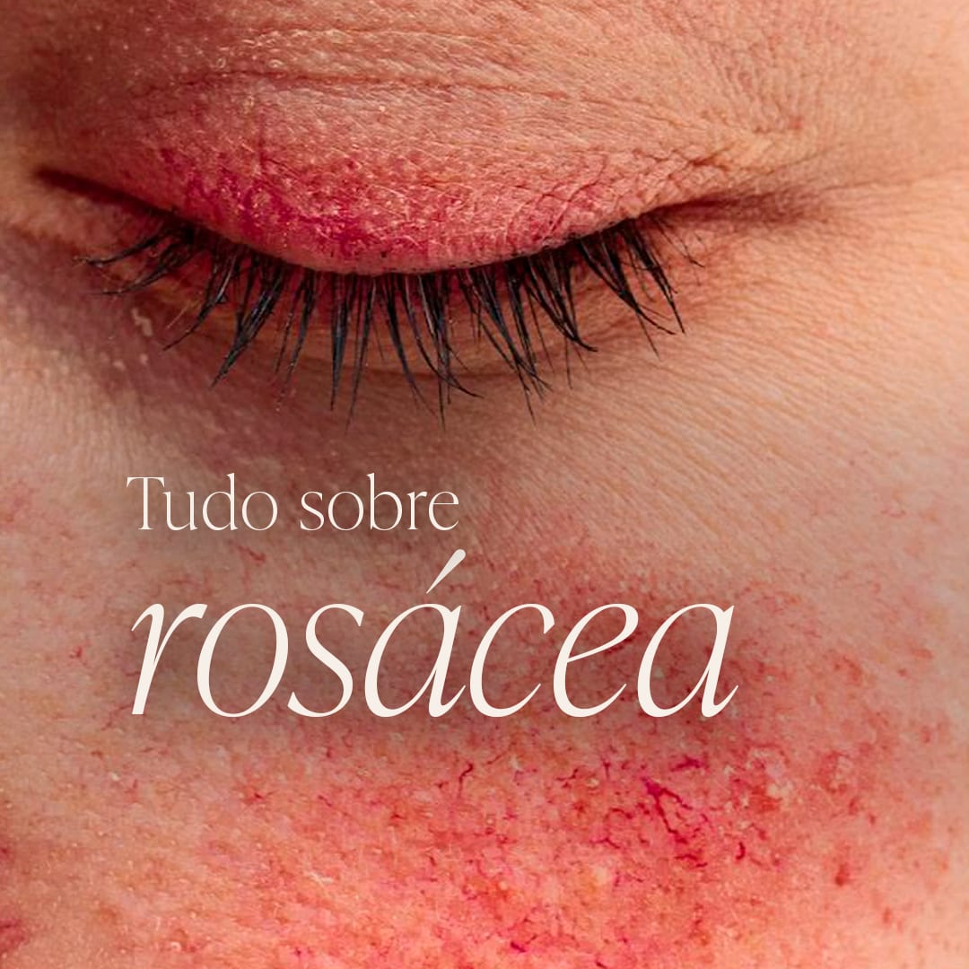 Publicação: tudo sobre rosácea.